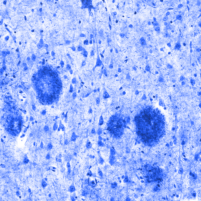 Press Release - SERCA Activator reducing cellular stress and preventing cell loss in neurons